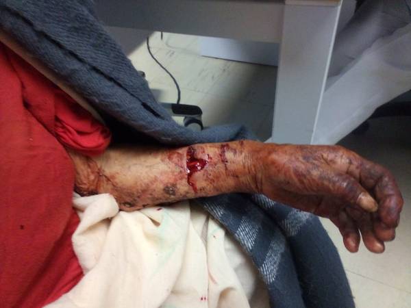 Anciana atacada por 2 pitbull.