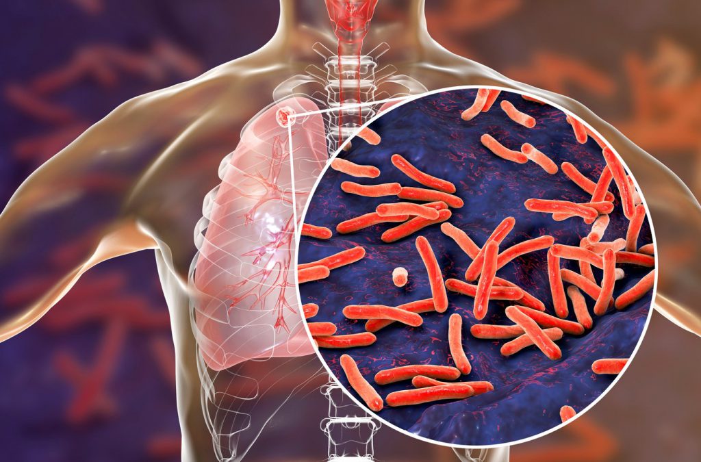 Personas con tuberculosis no reciben tratamiento