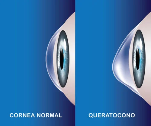 Enfermedad degenerativa Queratocono