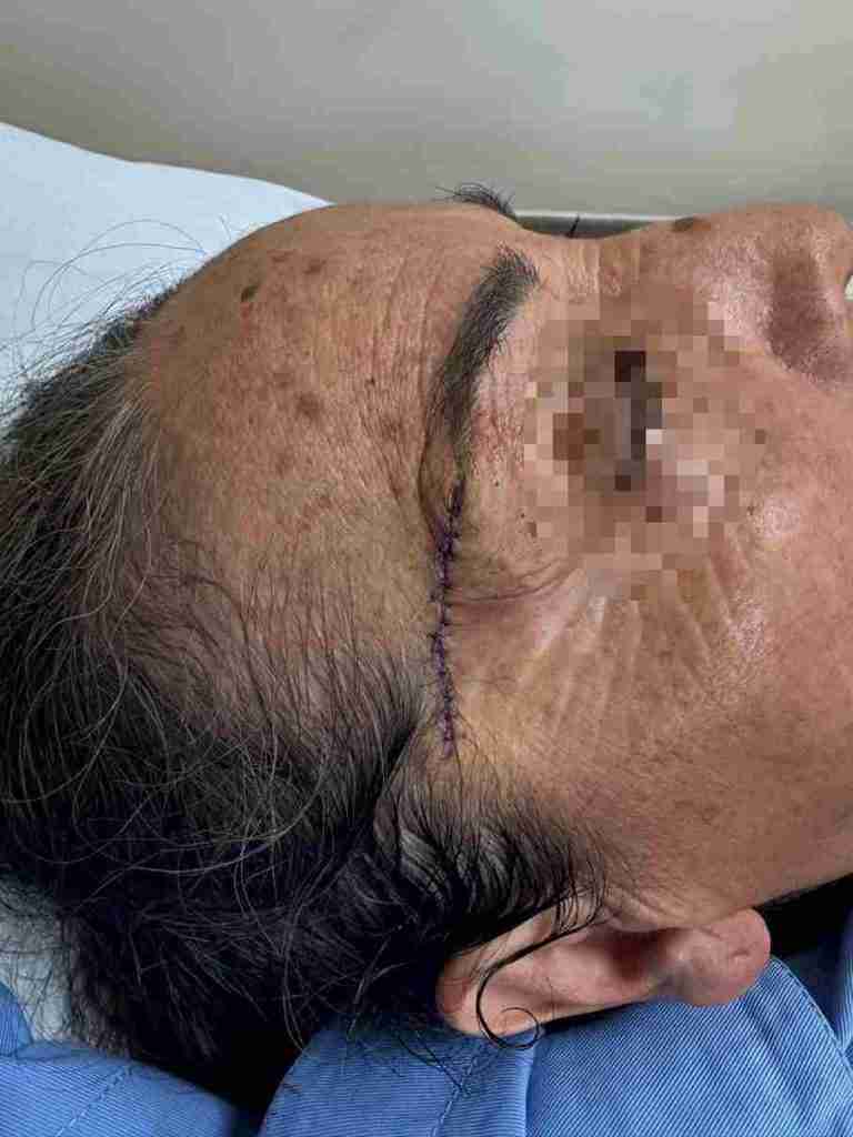 Casos reales de pacientes operado por cáncer de piel.