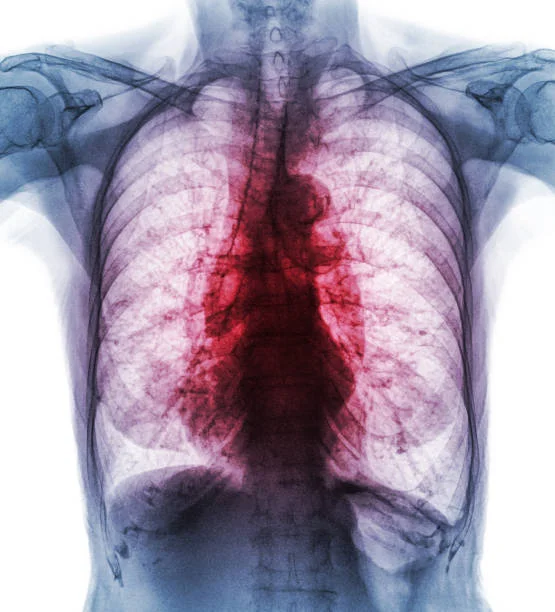 Riobamba registra 35 casos anuales de tuberculosis