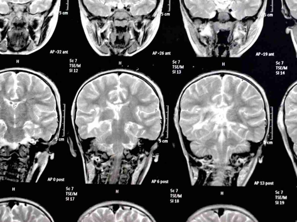 Linfoma cerebral, el raro cáncer que enfrenta Raphael