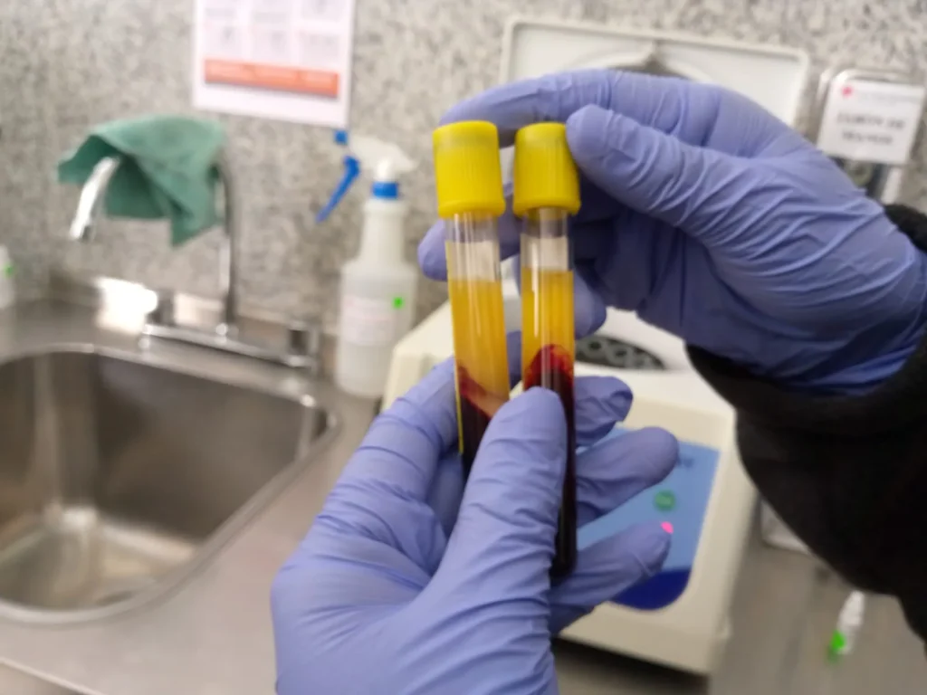 Muestras de sangre para exámenes de VIH.